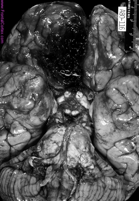 Ruptured anterior communicating artery aneurysm, status post clipping